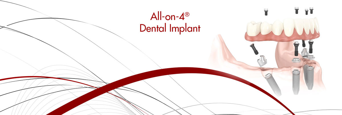 Hawthorne All-on-4 Dental Implants