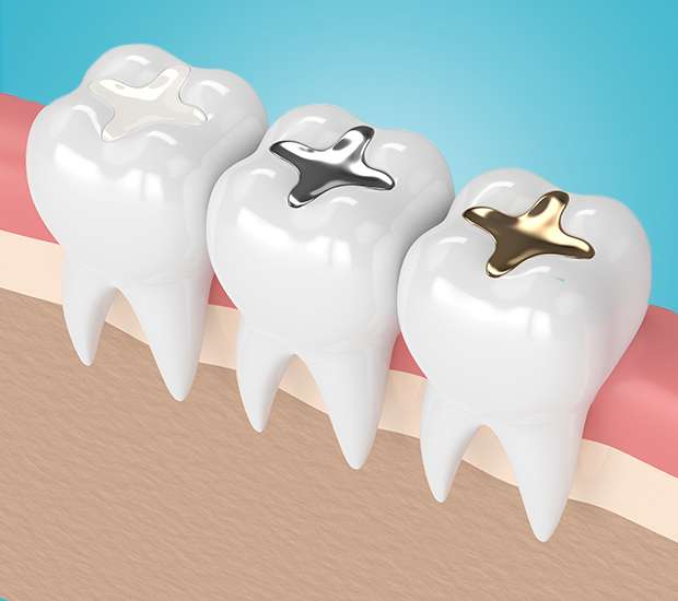 Hawthorne Composite Fillings