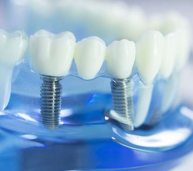 Hawthorne Dental Implants