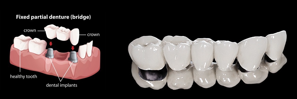 Hawthorne Dentures