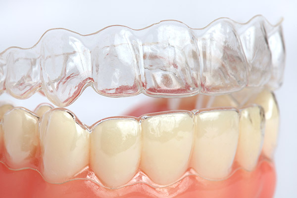Clear Braces After Tooth Loss