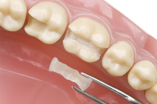 Are There Options For Dental Filling Material?
