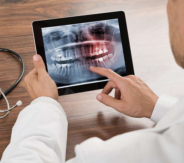 Hawthorne Types of Dental Root Fractures