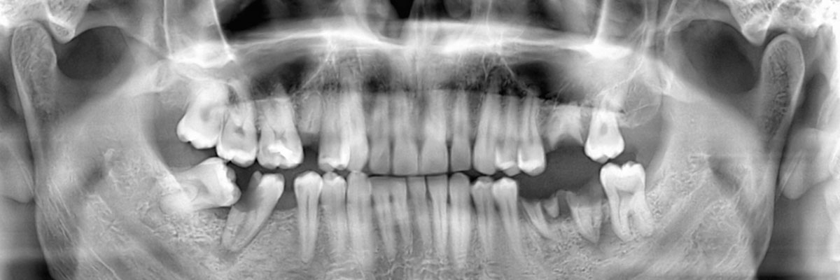Hawthorne Wisdom Teeth Extraction